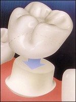Illustration of a Zirconia dental crown being placed over a natural tooth.