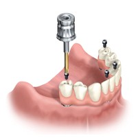 An illustration of an all-on-four dental implant overdenture, held in place with four implants and the denture is screwed onto the top of them.