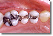 A photograph of several teeth with amalgam fillings that are not mercury-free.