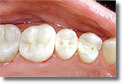 A photograph of the same teeth pictured above with the amalgam replaced with mercury-free composite fillings.