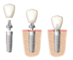 Three side by side images of dental implants with their crown being placed.