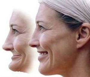 Two images of the same woman: one before facial collapse and one after