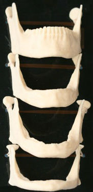 dental jaw models demonstrating the progression of facial collapse