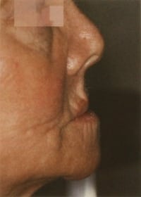 Image of patient with facial collapse