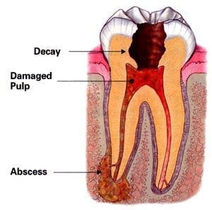diagram of an infected tooth