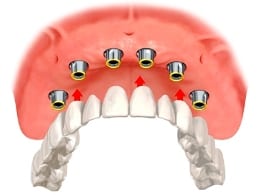 an image of implant of overdentures