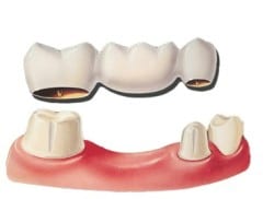 Illustration of a dental bridge