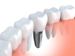 Image of a dental implant in the arch of teeth