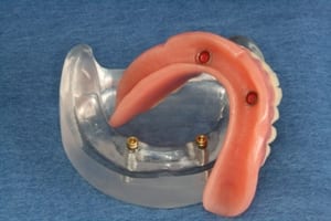 An example of snap on dentures