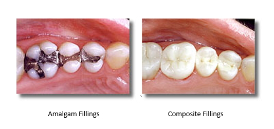 Images before and after mercury-free fillings