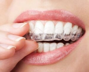 An image of Invisalign and teeth whitening used together