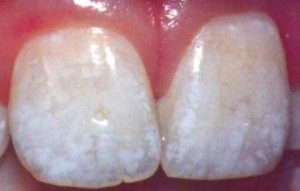 White spots on teeth