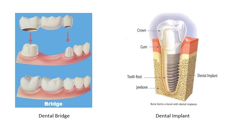 Illustration of a dental bridge next to a dental implant