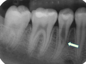 X-ray of a cavity on the inside of a tooth