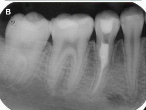 An image of an internal repaired by a root canal treatment.
